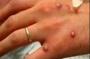 The news comes after the World Health Organisation declared monkeypox a global health emergency on June 23